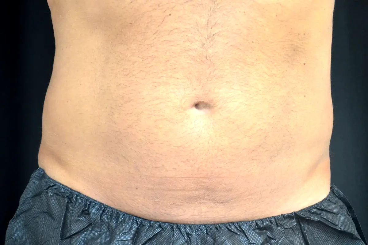 Après traitement CoolSculpting, abdomen
