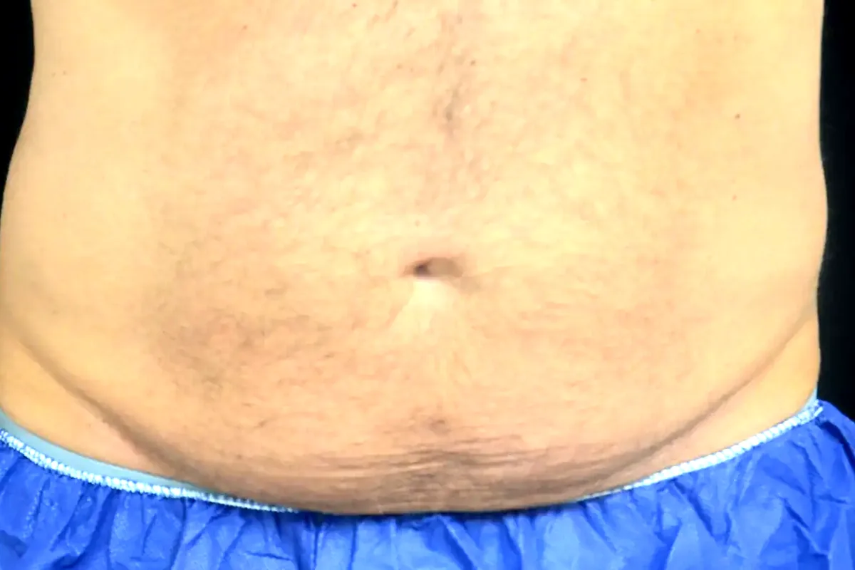 Avant traitement CoolSculpting, abdomen