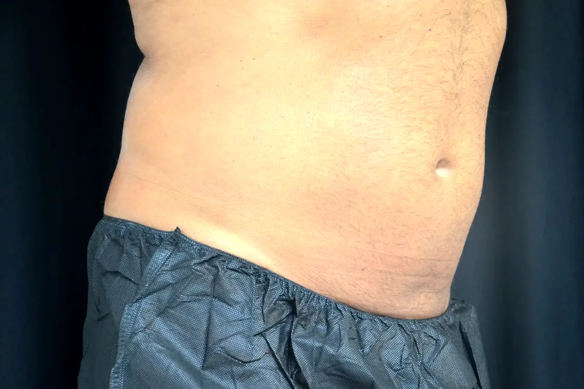 Après traitement CoolSculpting, abdomen