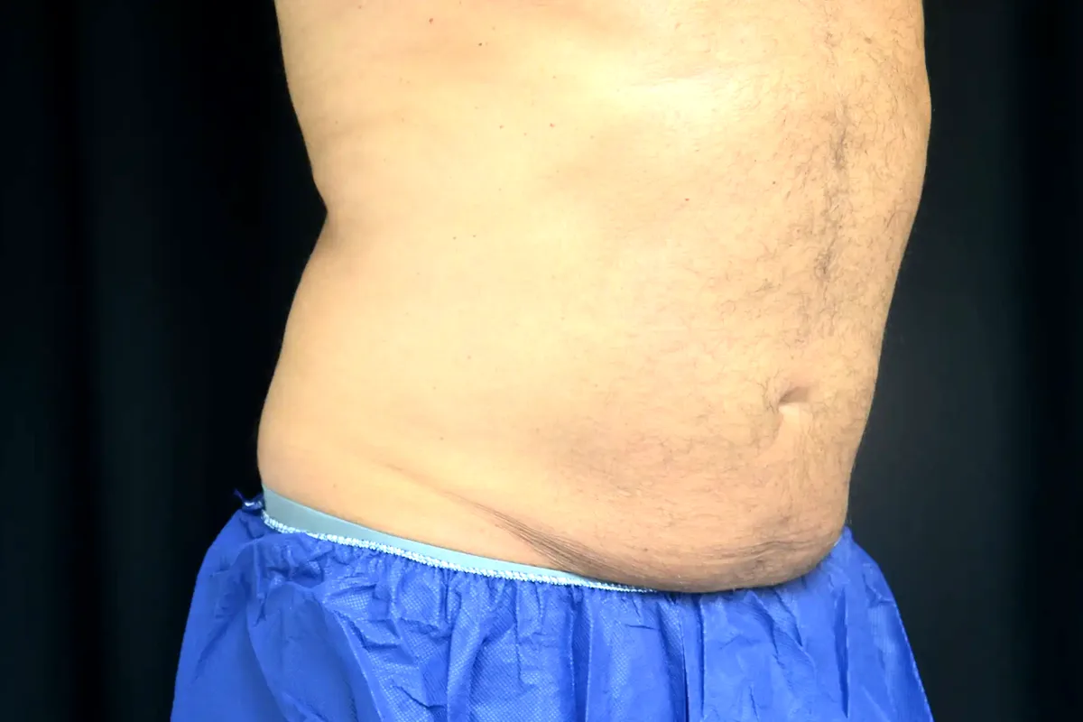 Avant traitement CoolSculpting, abdomen