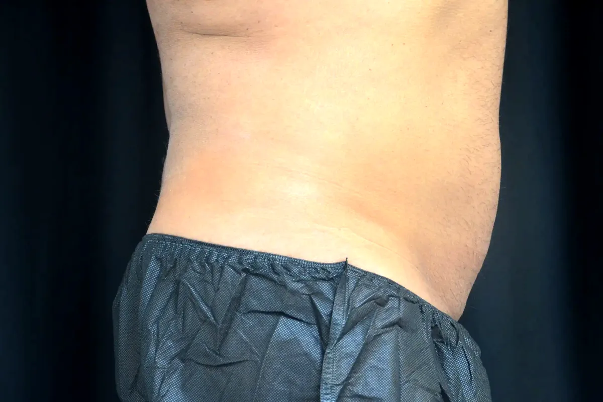 Après traitement CoolSculpting, abdomen