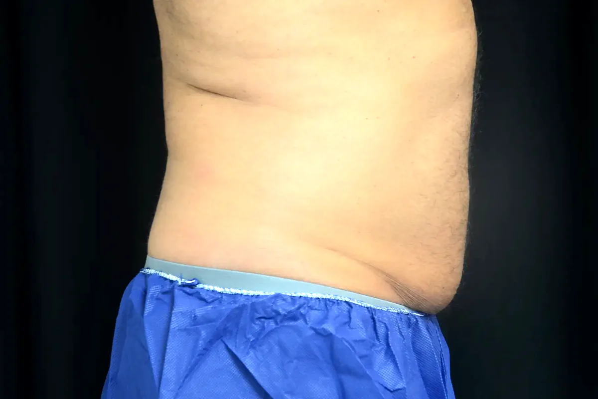 Avant traitement CoolSculpting, abdomen