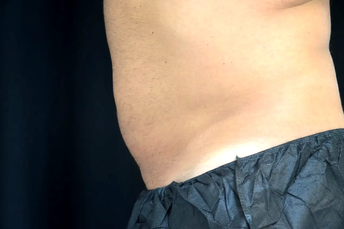 Après traitement CoolSculpting, abdomen