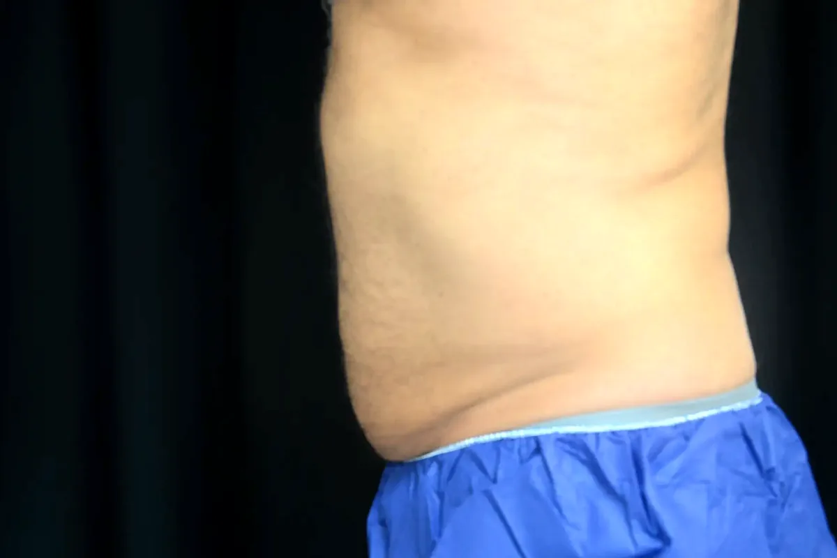 Avant traitement CoolSculpting, abdomen