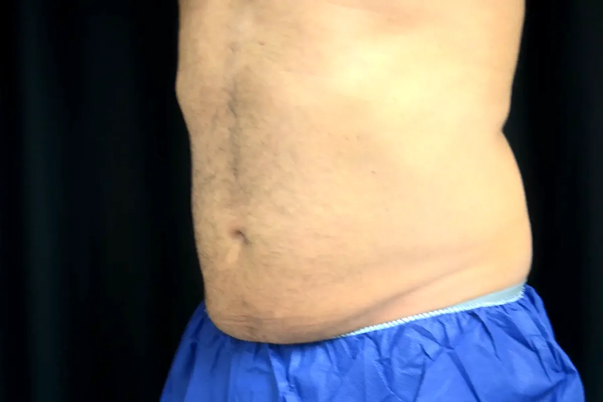 Avant traitement CoolSculpting, abdomen