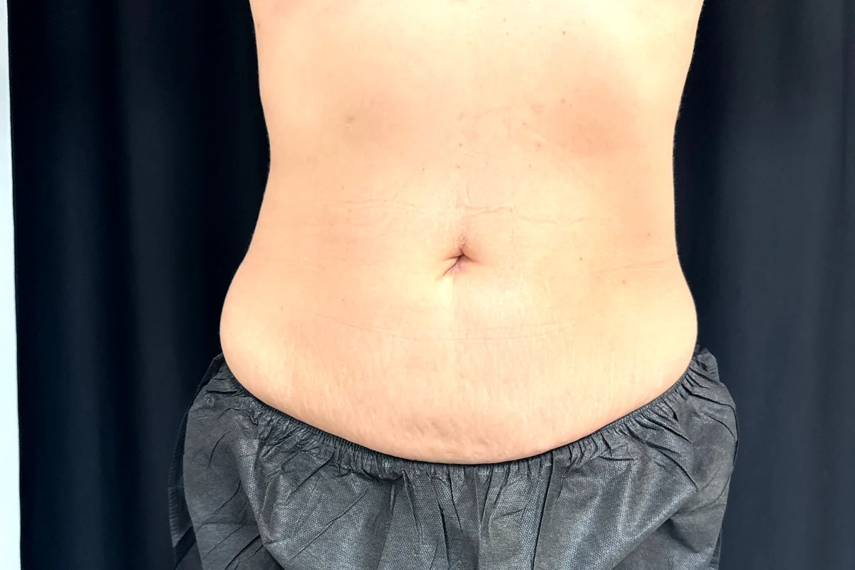Après traitement CoolSculpting, abdomen