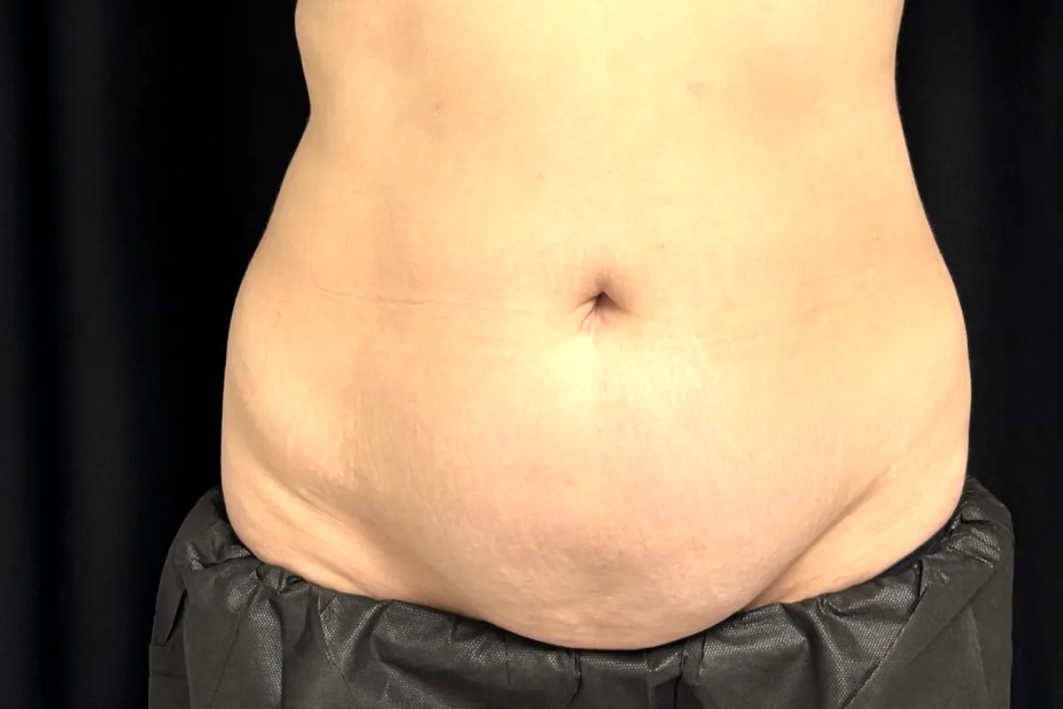 Avant traitement CoolSculpting, abdomen