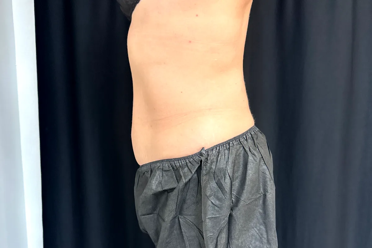 Après traitement CoolSculpting, abdomen