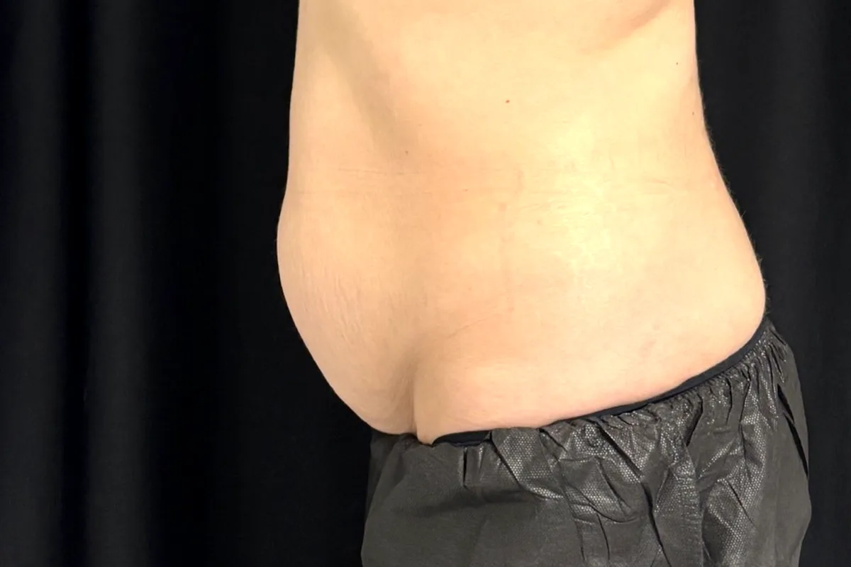 Avant traitement CoolSculpting, abdomen