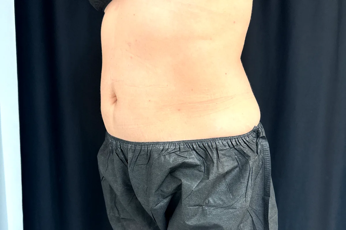 Après traitement CoolSculpting, abdomen