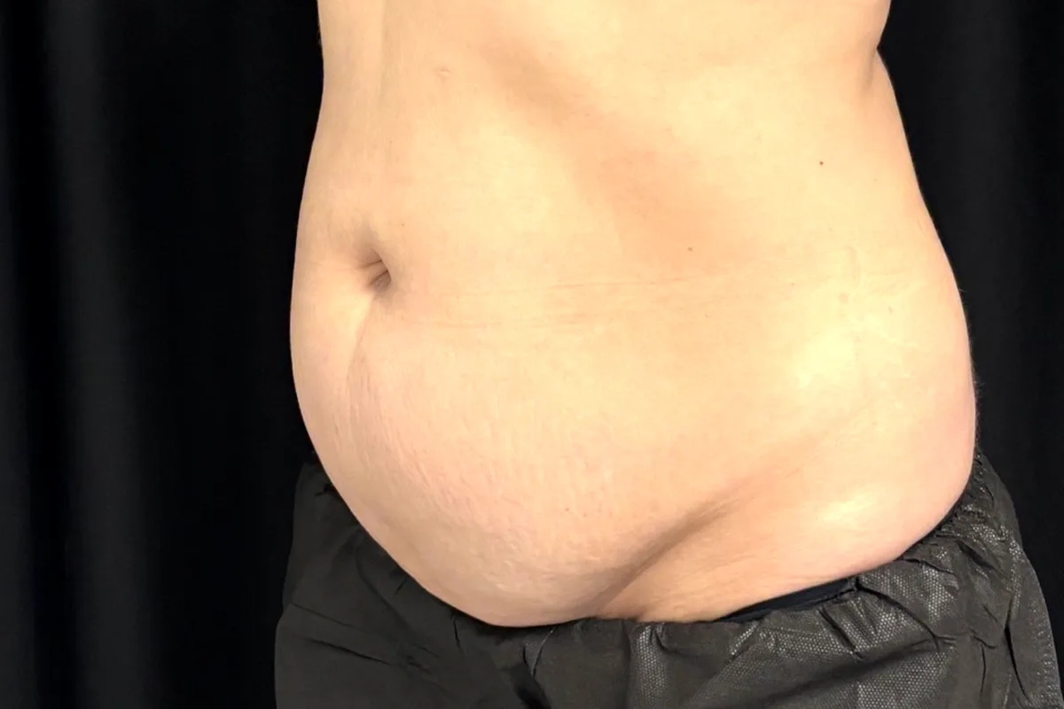 Avant traitement CoolSculpting, abdomen
