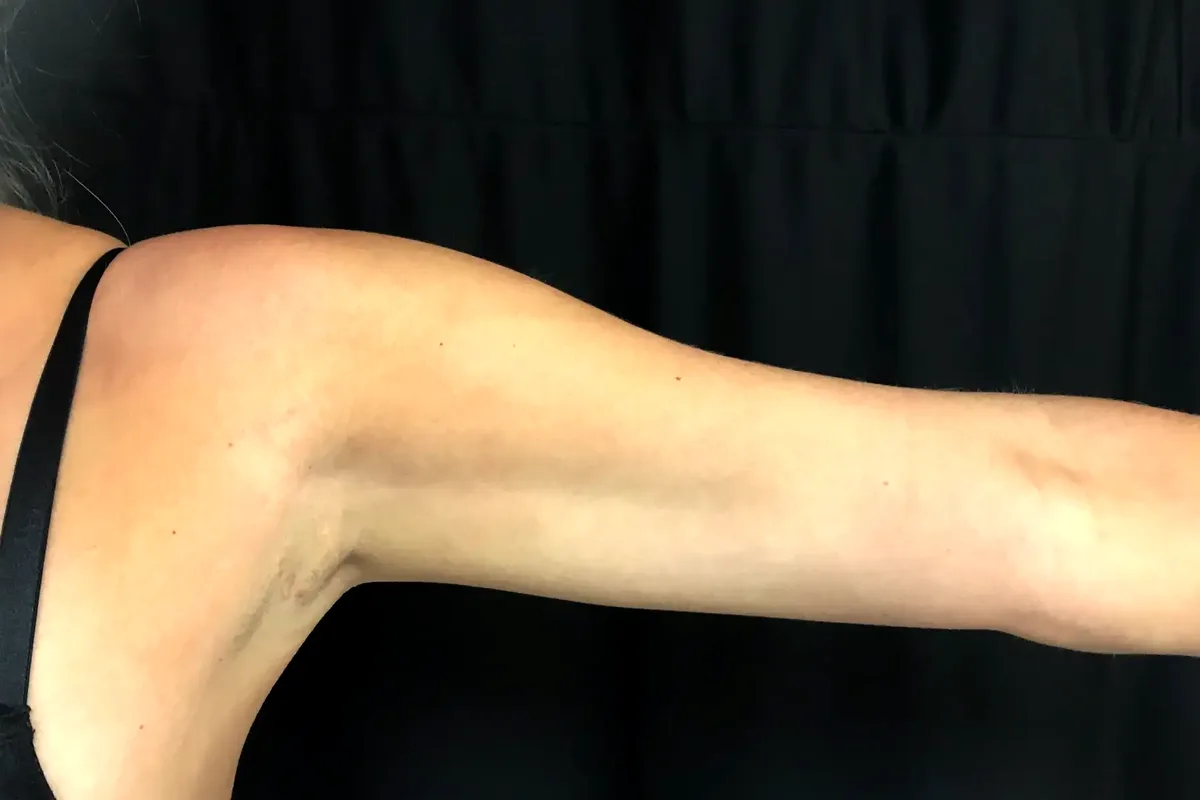 Après traitement CoolSculpting, bras