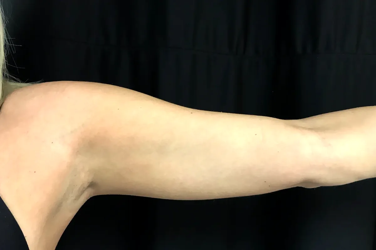 Avant traitement CoolSculpting, bras
