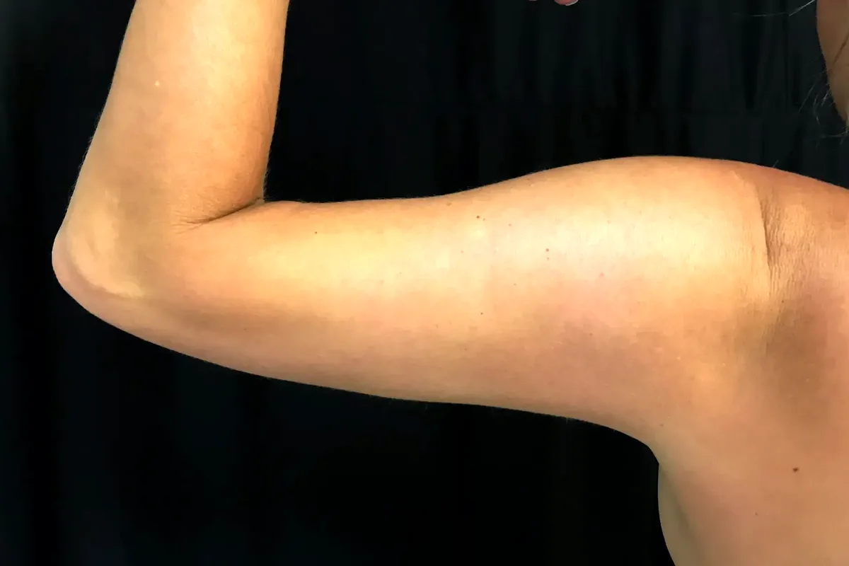 Après traitement CoolSculpting, bras