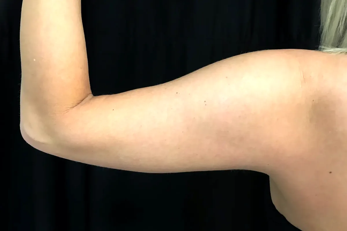 Avant traitement CoolSculpting, bras