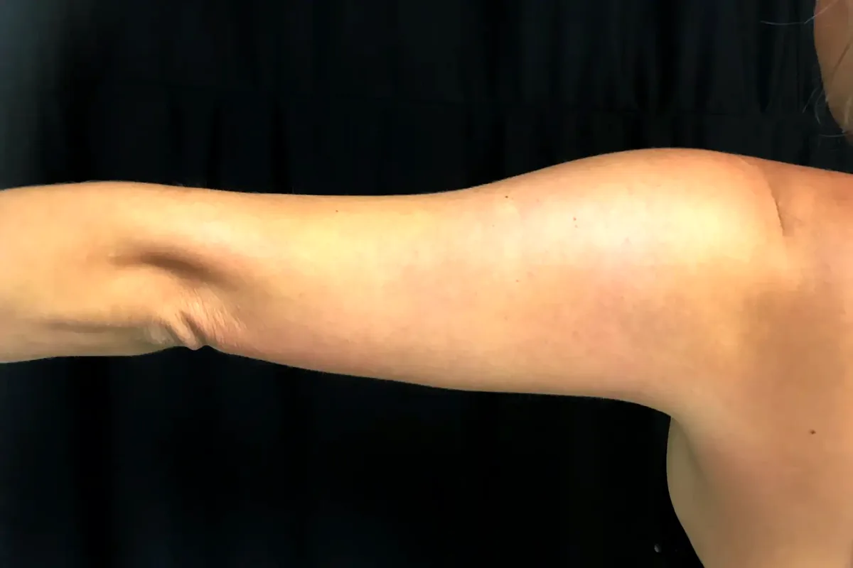 Après traitement CoolSculpting, bras