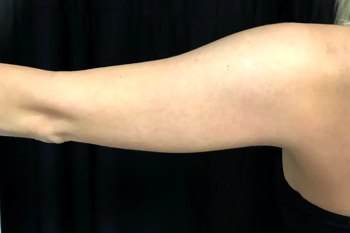 Avant traitement CoolSculpting, bras