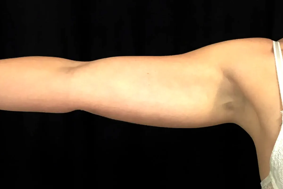 Après traitement CoolSculpting, bras