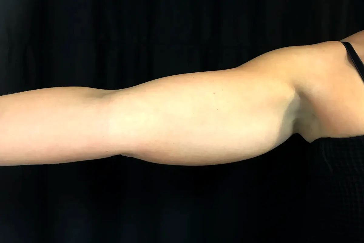 Avant traitement CoolSculpting, bras