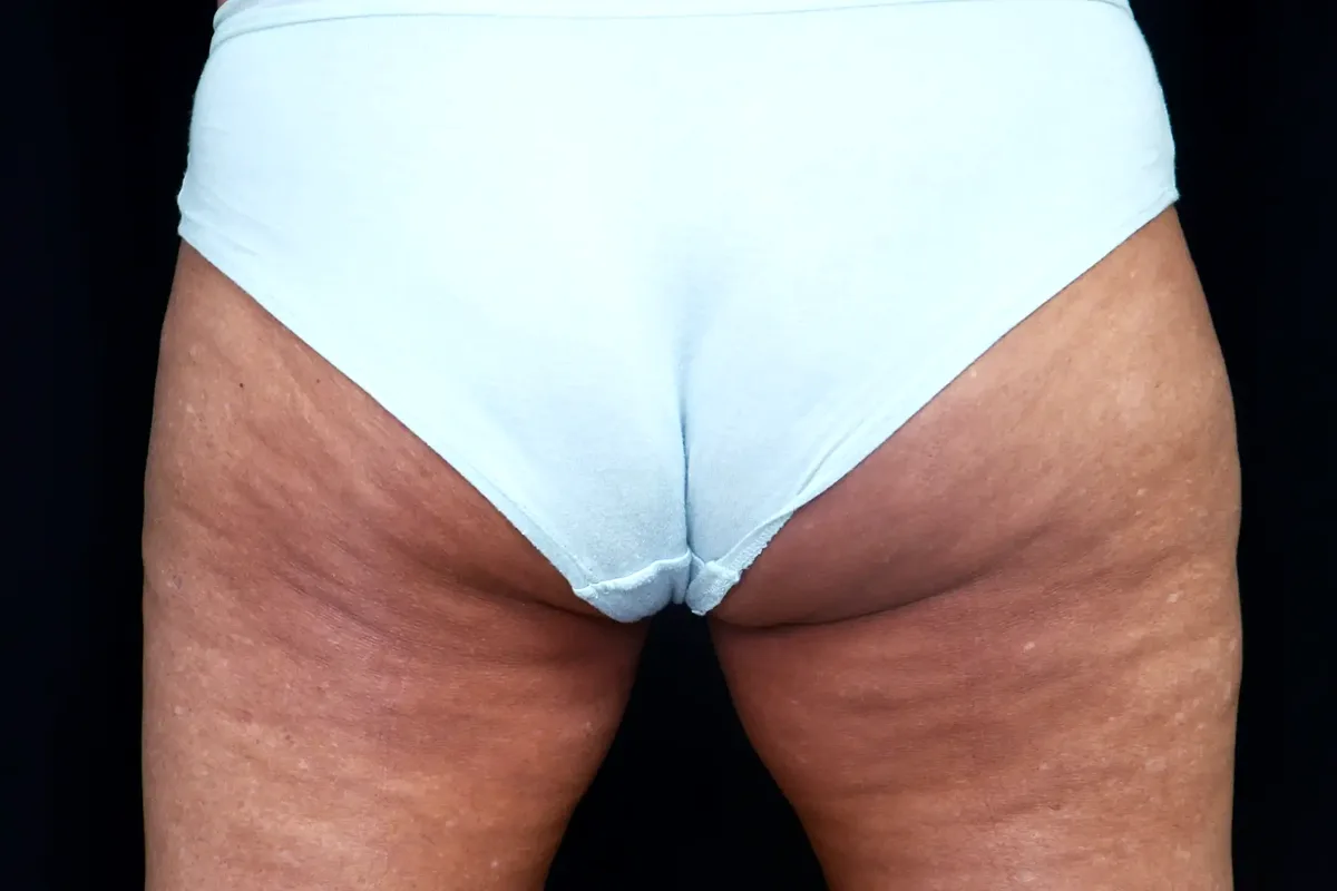Après traitement CoolSculpting, cuisses