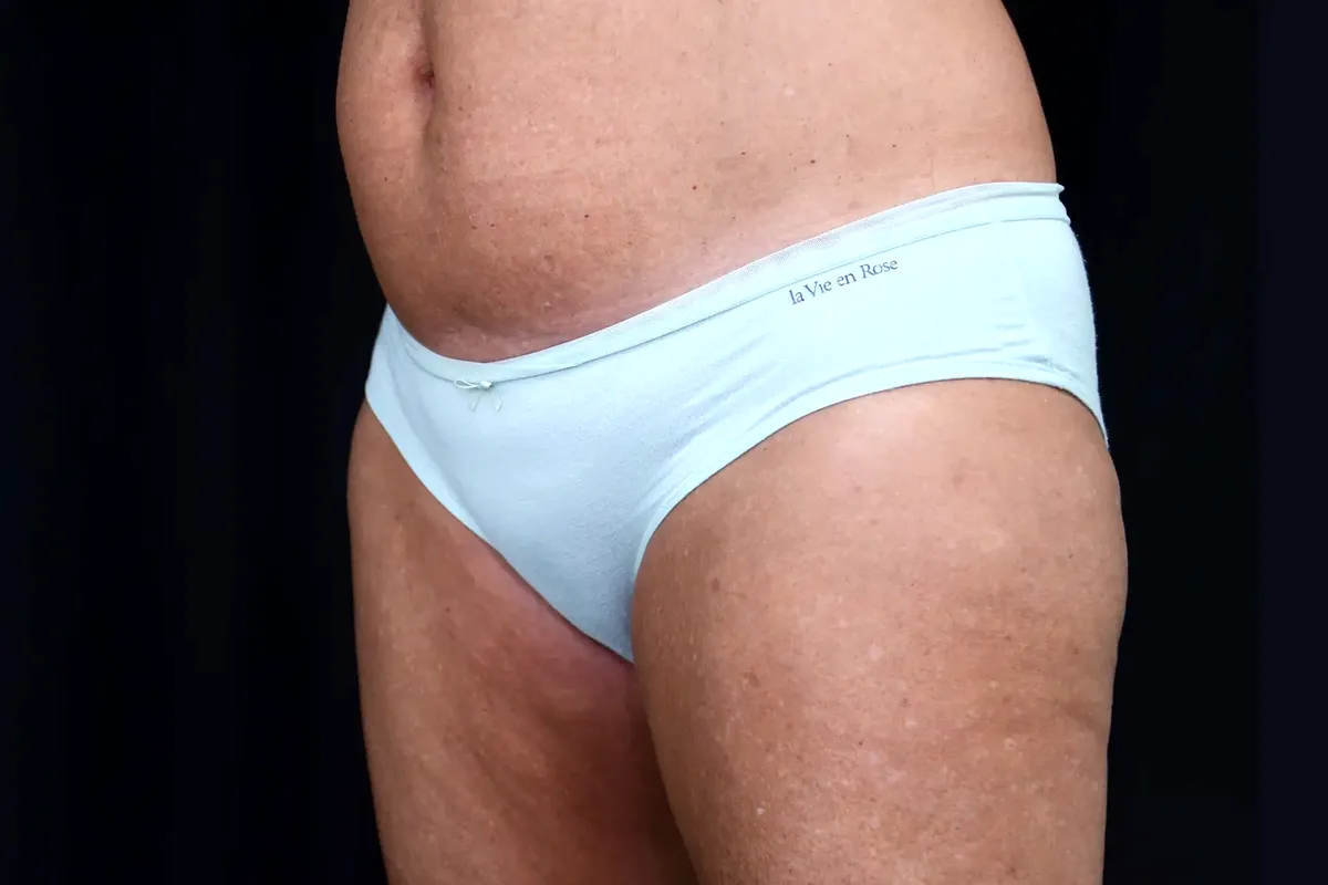 Après traitement CoolSculpting, cuisses
