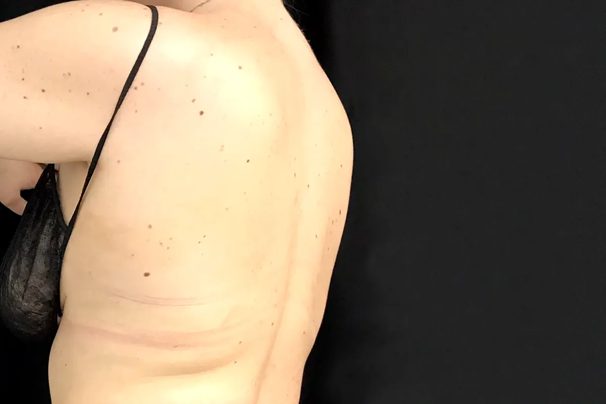 Après traitement CoolSculpting, dos