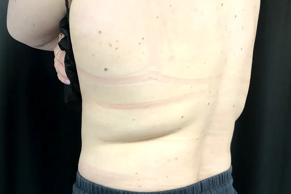 Avant traitement CoolSculpting, dos