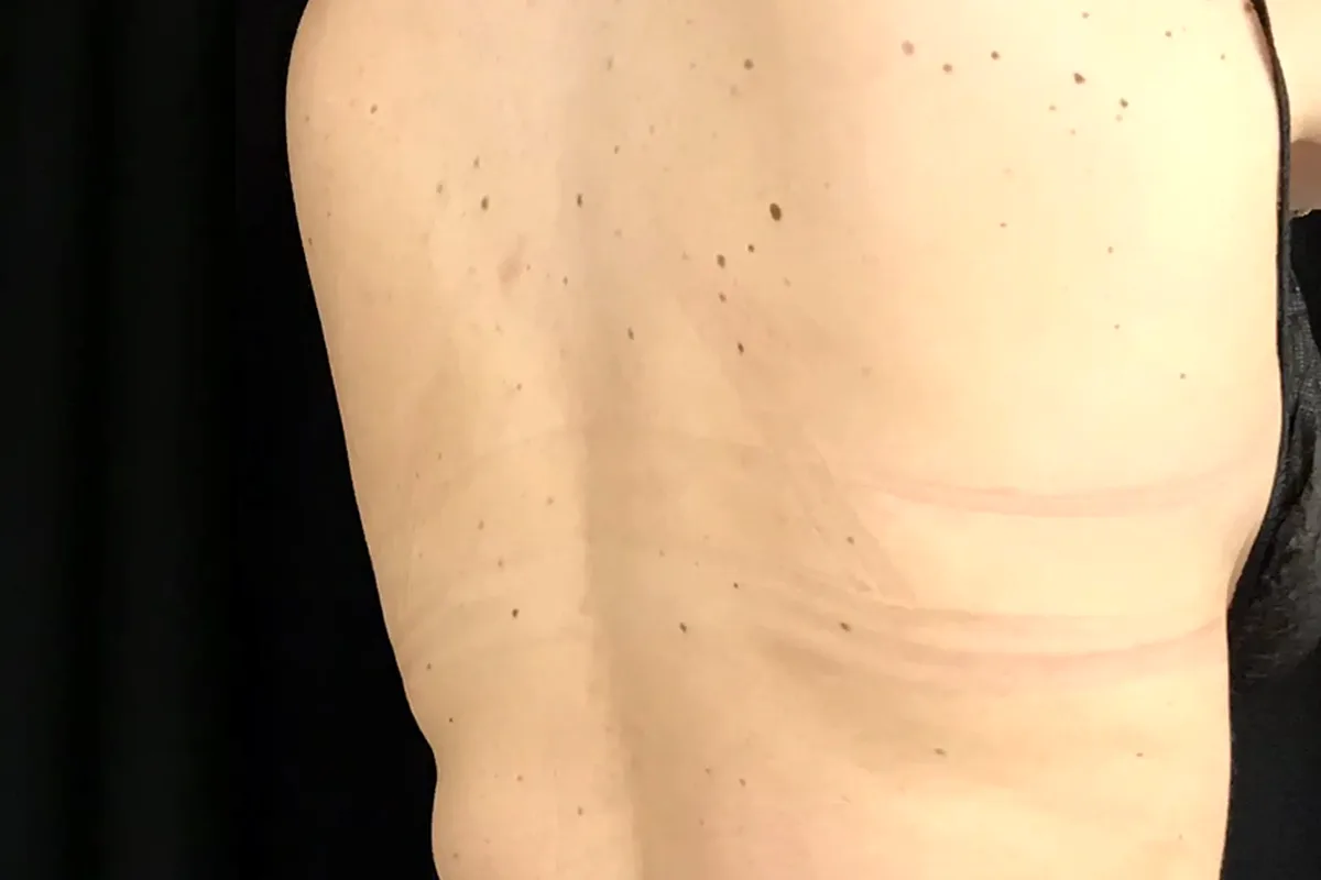 Après traitement CoolSculpting, dos