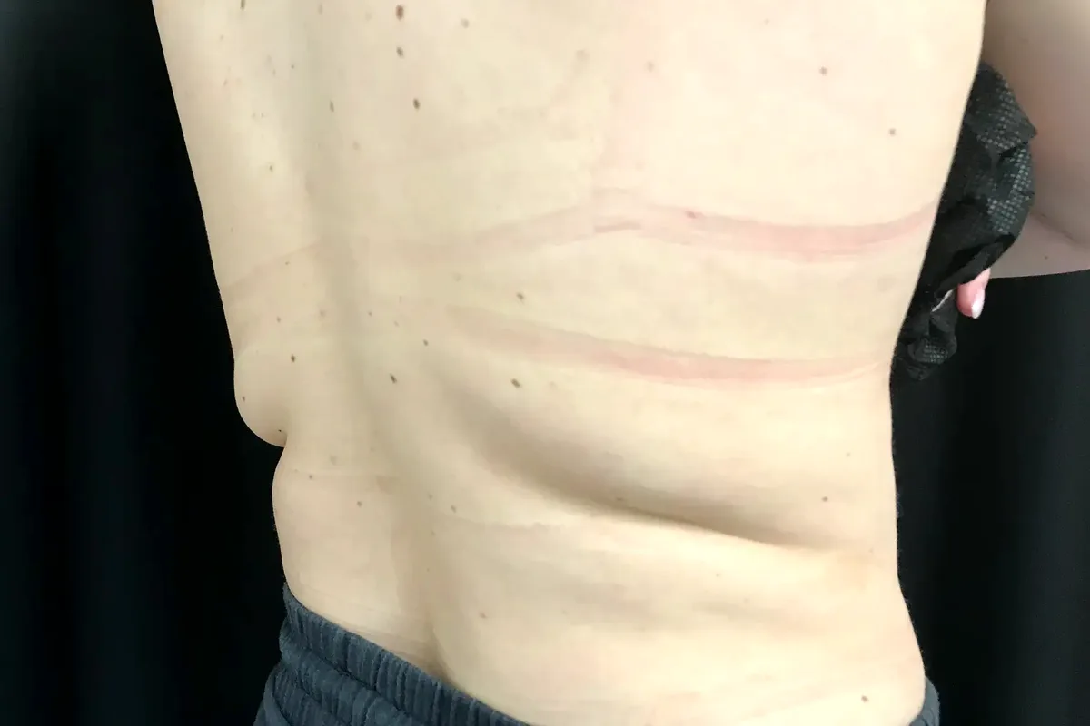 Avant traitement CoolSculpting, dos