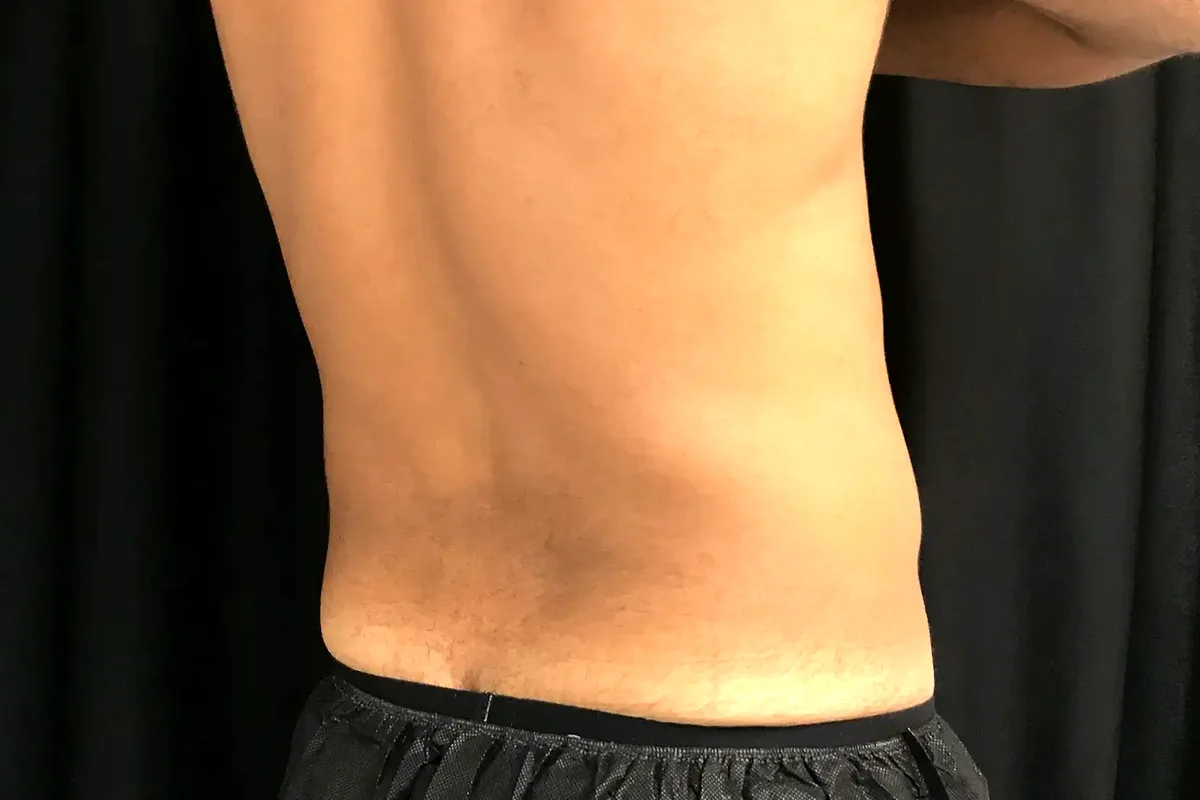 Après traitement CoolSculpting, flancs