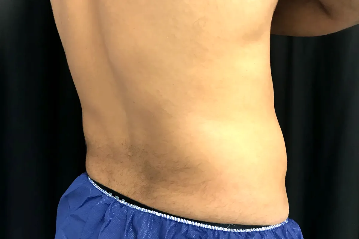 Avant traitement CoolSculpting, flancs