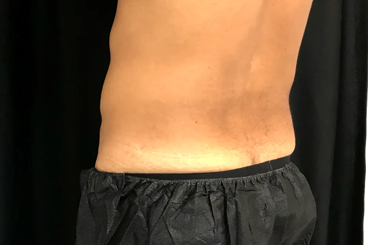 Après traitement CoolSculpting, flancs