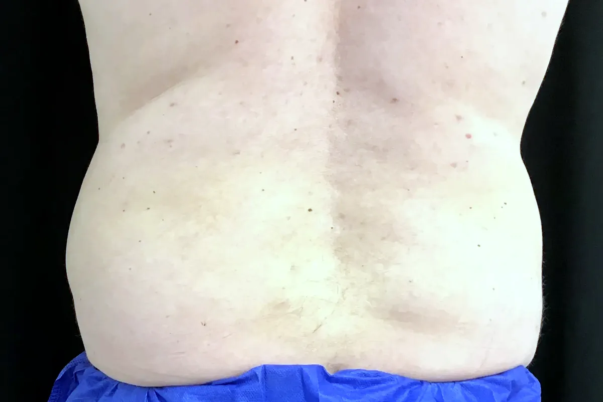 Après traitement CoolSculpting, flancs