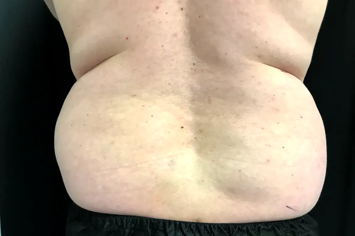 Avant traitement CoolSculpting, flancs