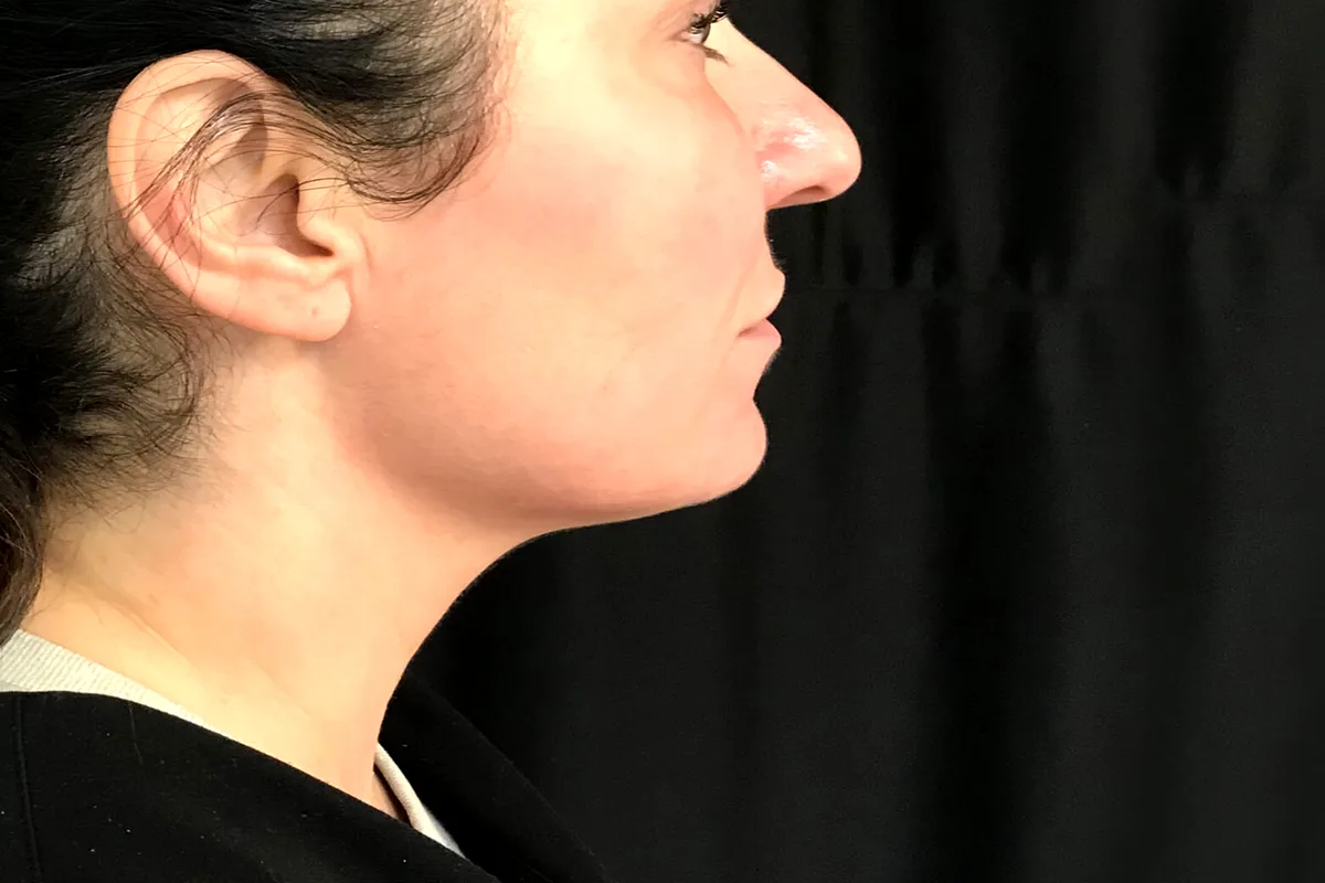 Après traitement CoolSculpting, double menton