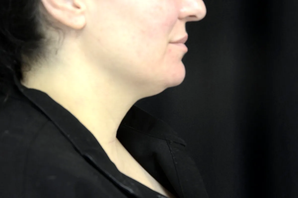 Avant traitement CoolSculpting, double menton