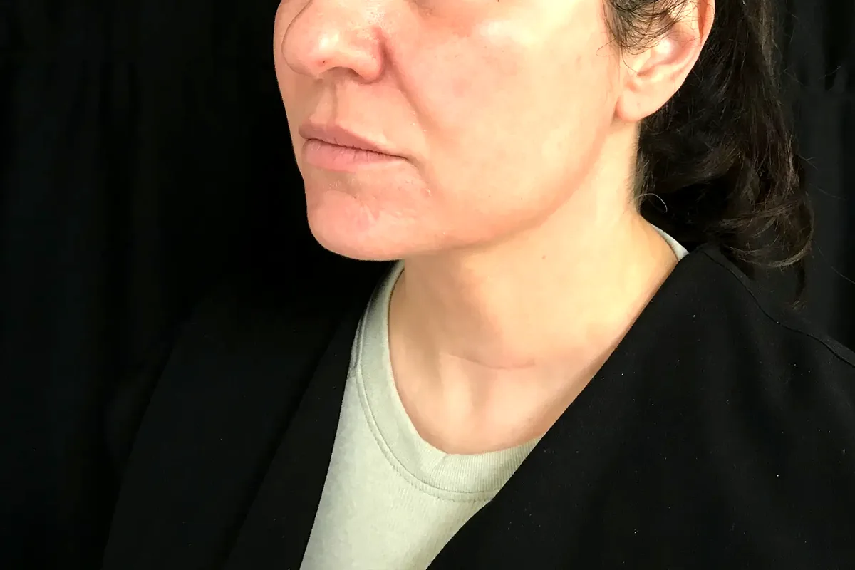Après traitement CoolSculpting, double menton