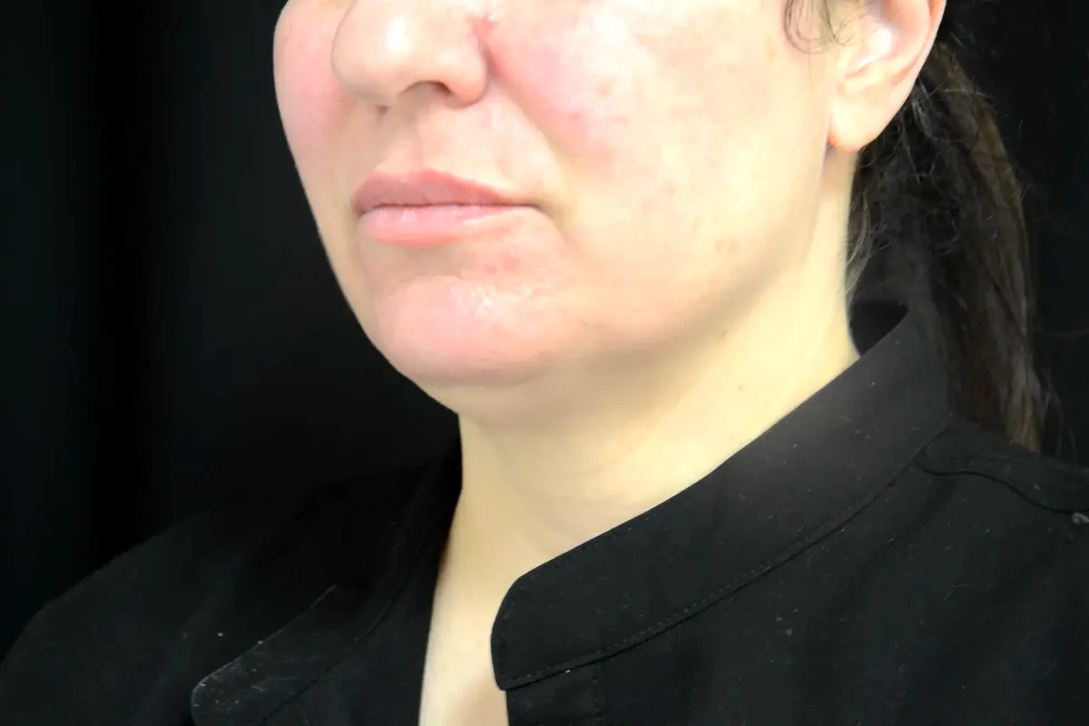 Avant traitement CoolSculpting, double menton