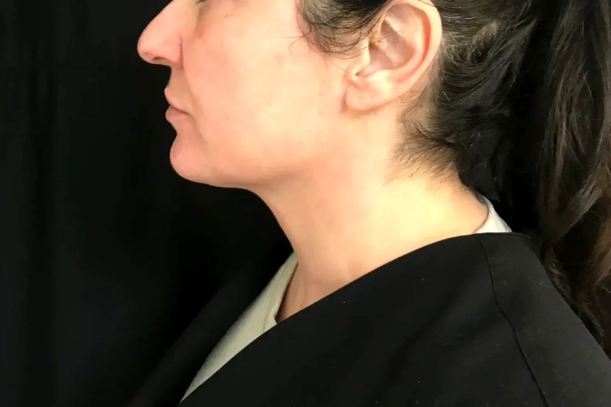 Après traitement CoolSculpting, double menton