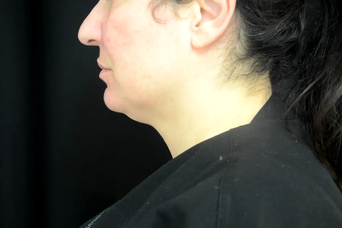 Avant traitement CoolSculpting, double menton